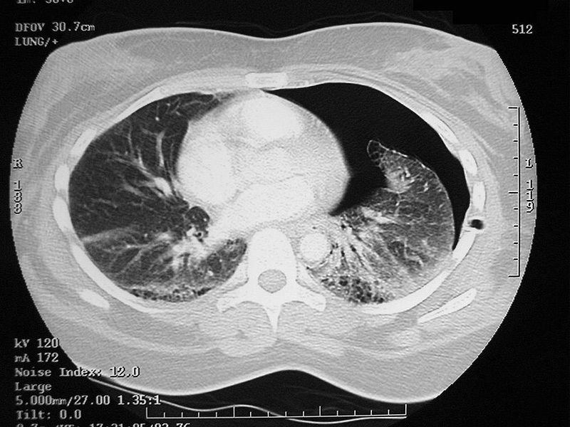 Two forgotten signs in pneumothorax 800px-10