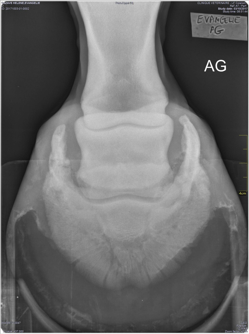 ossification avancée des fibros  cartilages,curable ou pas? - Page 2 Antyri11