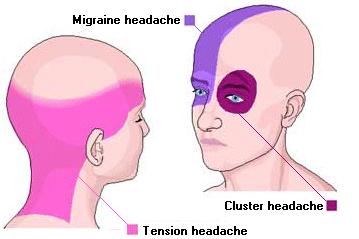 ماذا تعرف عن الصداع Headac10