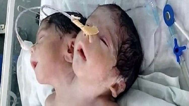 ولادة طفل برأسين في الهند (فيديو) 59faf610