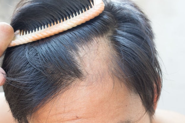 ثعلبة فروة الرأس البقعية Scalp alopecia areata 10841311