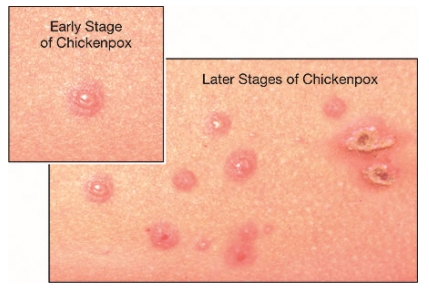 Chicken Pox مرض العنقز جدري الماء