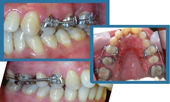 Cas cliniques : Les limites de l'abstention [Orthodontie] Traite10