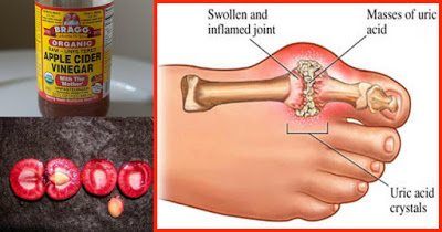 Remove Uric Acid from your body and reduce joint pain with this simple ingredient 02-rem10