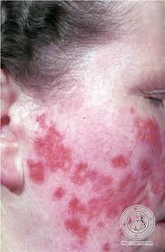 image d'une tuberculose cutanée Images10