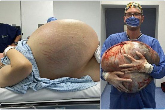 Une femme s’est fait retirer une tumeur à l’ovaire de 60kg 08de5510