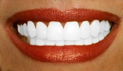 un KAWA en TERRASSE - Blanchiment des dents à la lampe LED : risques ou pas ?   13905810