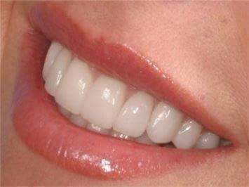 اسهل ثلاث طرق لتبييض الاسنان Fb_img24