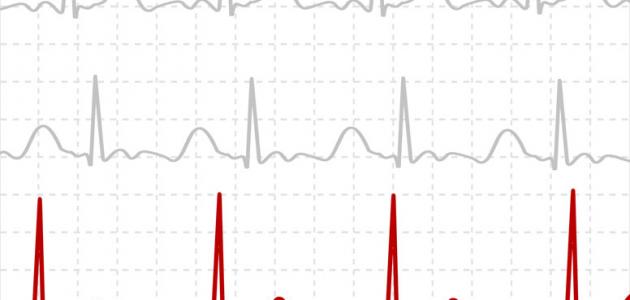[شرح] كيفية قراءة رسم القلب ECG Fdd10