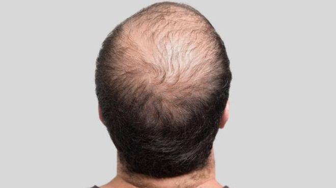 اكتشاف علاج جديد يوقف تساقط الشعر ويحارب الصلع Xcarol13