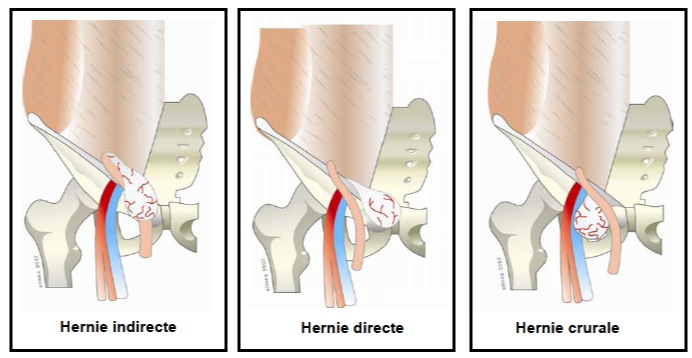 hernies directes, indirectes et crurales  Typesh10