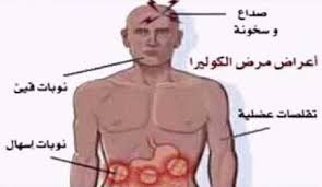 اعراض الكوليرا لدى الانسان 1613