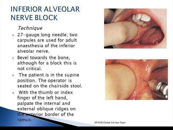 Proper position & location of anatomy  landmarks for Inferior alveolar n. Block Fb_img11