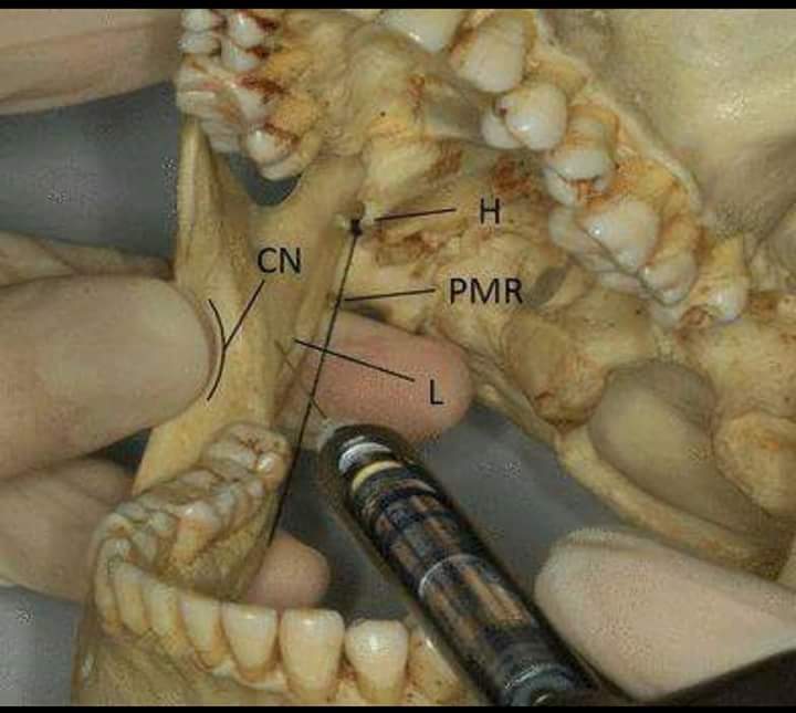 Proper position & location of anatomy  landmarks for Inferior alveolar n. Block Fb_img15