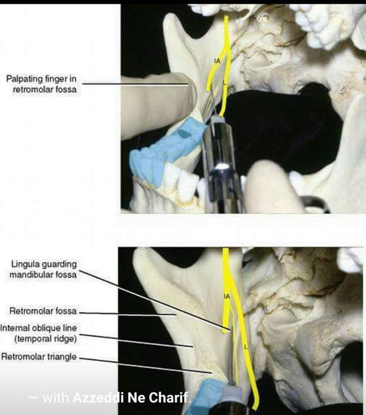 Proper position & location of anatomy  landmarks for Inferior alveolar n. Block Fb_img18