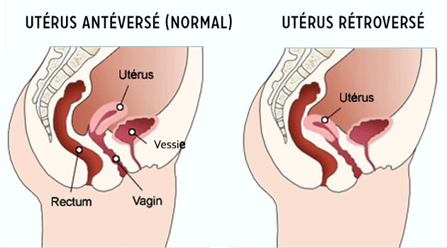 Qu'est-ce qu un utérus Retroversé ? Uterus10