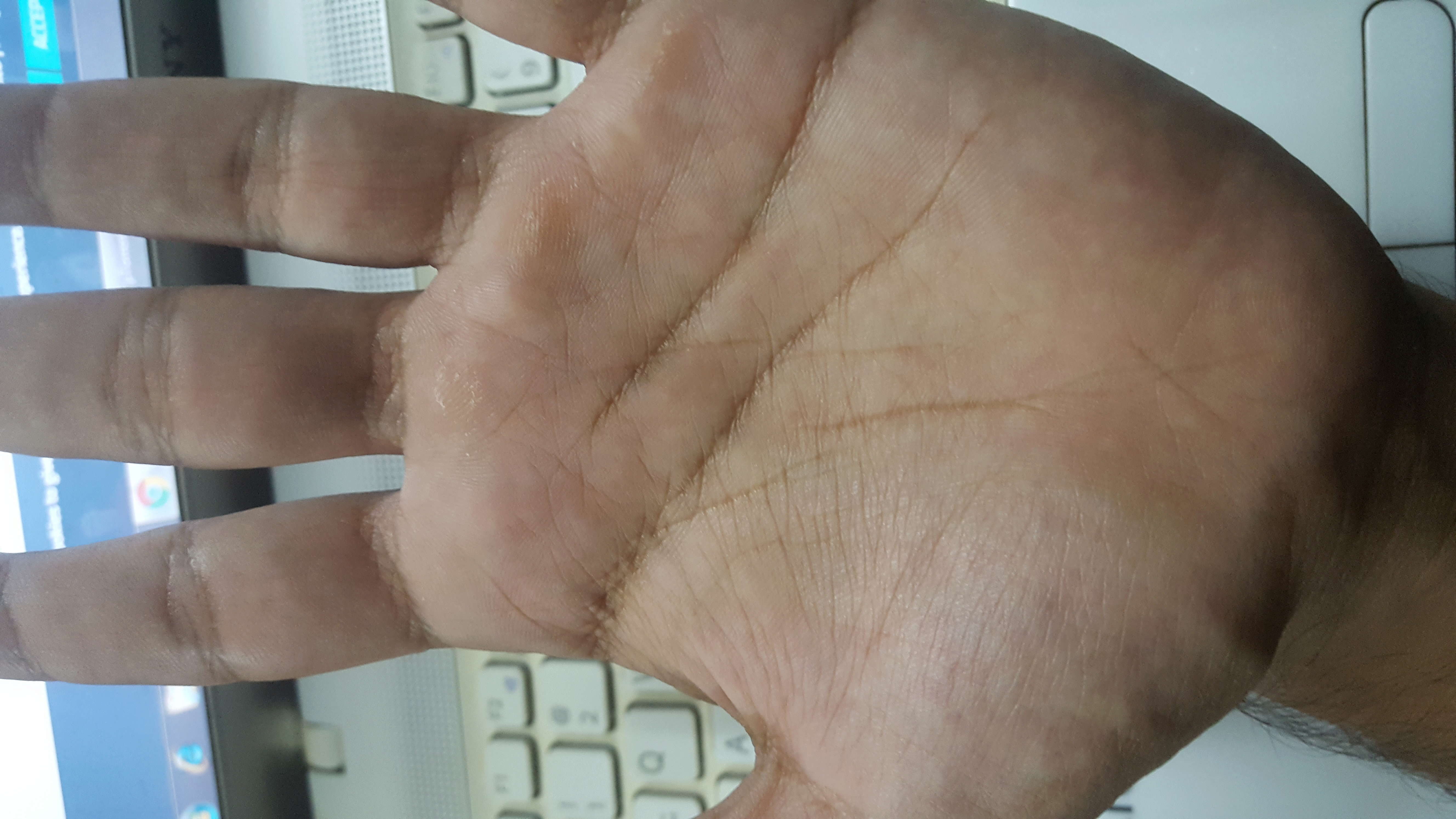life line broken in both hands 20180510