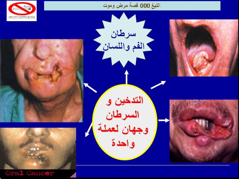 التدخين مضر بالصحة-اليوم العالمي لمحاربة التدخين 31 ماي- Sans_t72