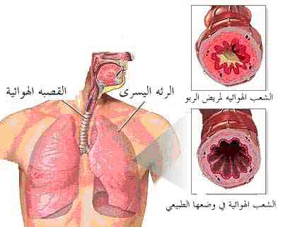  التهاب القصبات المزمن Image011