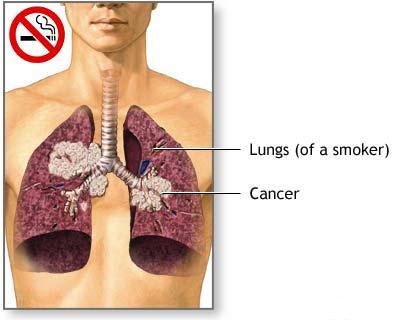 مـجـرد فـحـص قـد يـنـقـذ مـرضـى سـرطـان الـرئـة Lung10