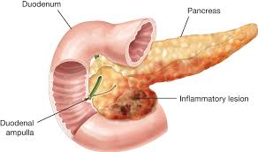 I. Pancreatitis