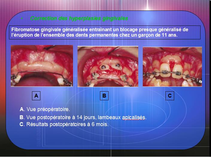 Les interrelations Parodonto-Orthodontiques 110