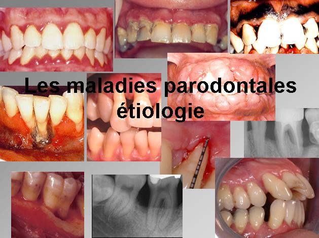 Etiologies des Maladies Parodontales Atio10