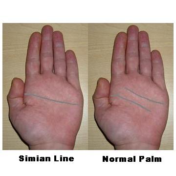 Simian Line / Single Transverse Palmar Crease Simian11