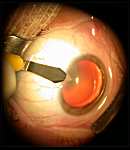 L'intervention chirurgicale de la cataracte  Catara12