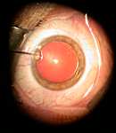 L'intervention chirurgicale de la cataracte  Catara13