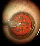 L'intervention chirurgicale de la cataracte  Catara16