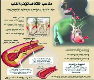 علاقة الأسنان والتهاب اللثة في أمراض القلب 26446410