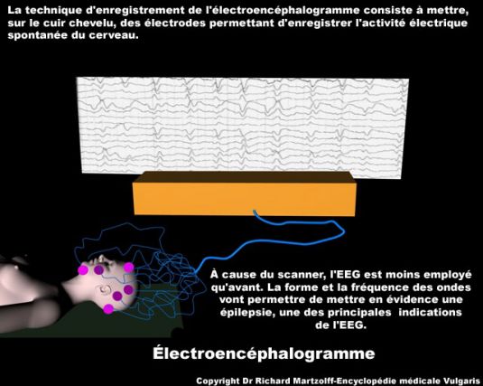 II] Les moyens technologiques d'exploration fonctionnelle du cerveau. L_alec11