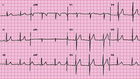 CHAPTER 4 : BASIC WAVES , HEART RATE