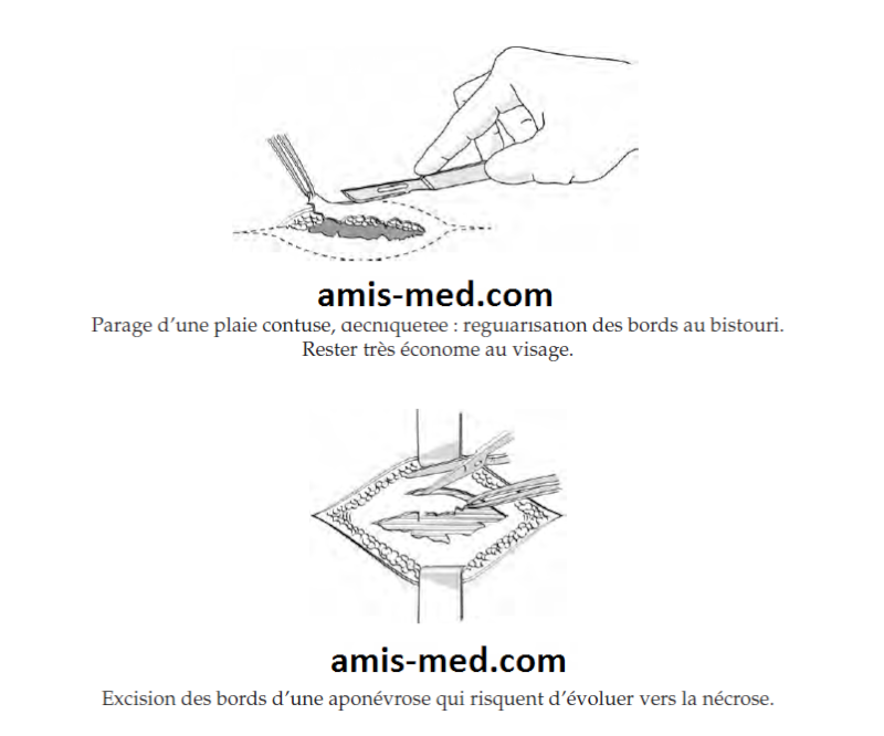 TECHNIQUE DE SUTURE o0O exculisivité amis-med O0o 444410