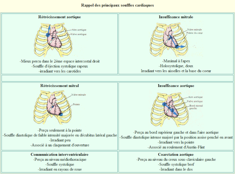 Les souffles cardiaques Souffl10