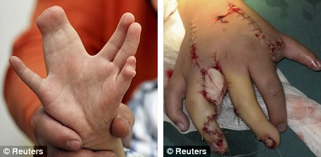 Un niño con 31 dedos recibe intervención quirúrgica Nino-c13