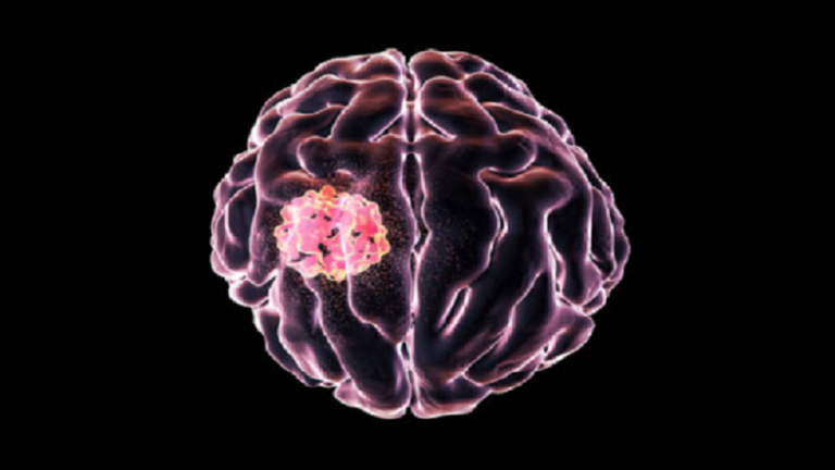 أعراض ورم الدماغ: ما هي العلامات الأكثر شيوعا للمرض؟ 5f846710