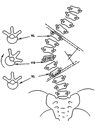 SCOLIOSE - HERNIE DISCALE - COMPRESSION MEDULLAIRE - MYELOPATHIE Scolio10