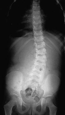 FORUM 1 - 09/2009 ARNOLD CHIARI (syndrome-malformation A.C.) - CARACTERISTIQUES - SYMPTOMES - DESCRIPTIONS SOMMAIRES - syringomyélie - Arnold Chiari syndrome (malformation-AC) - FEATURES - SYMPTOMS - BRIEF DESCRIPTION - syringomyelia - - Page 2 Scolio10