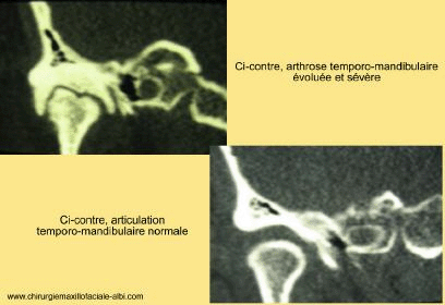 Pathologies rhumatologique de l'ATM A10