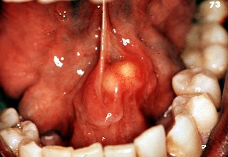 Mikulicz salivaire lacrymal (syndrome de) W210