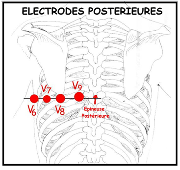 POSITION DES ELECTRODES PRECORDIALES 0110