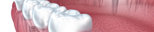 احدث الطرق في زراعة الاسنان 680-1210