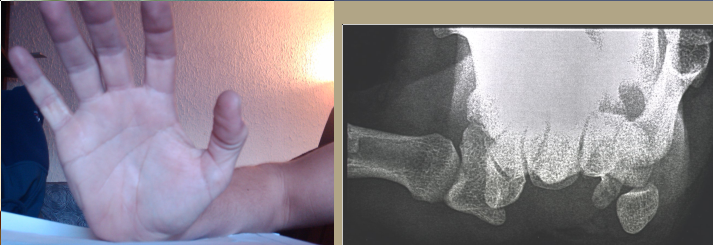 Fracture de l'apophyse unciforme de l'os crochu - patient eric white Asuppr17