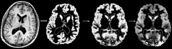 The Effect of Antipsychotic Treatment on Cortical Gray Matter Changes in Schizophrenia: Does the Class Matter?  White-10