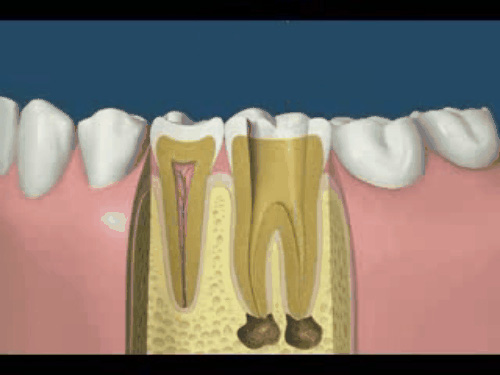 Xem quy trình chữa tủy răng khiến bạn... buốt hết cả răng 15121813