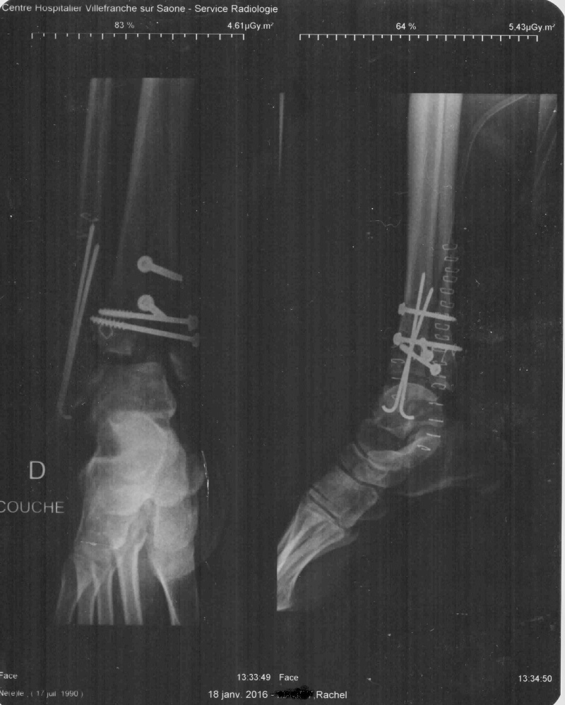Comment guérir une jambe (bêtement) cassée - Page 8 1-211