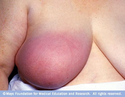 Kanker payudara..... & tips pencegahannya Images10