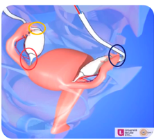 suspension de l ovaire - ligaments ovaire Captur19